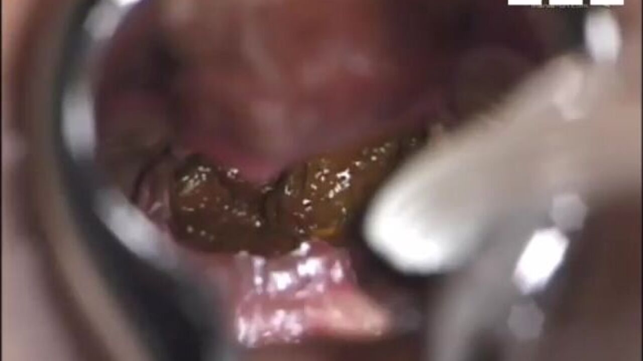 Watch this kinky scat porn video of a scat girl farting while pooping inside her asshole